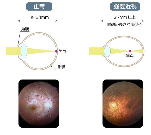 強度近視眼と正常眼の比較
